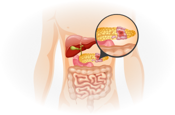 Diabetes – Types, Causes, Symptoms And Treatments