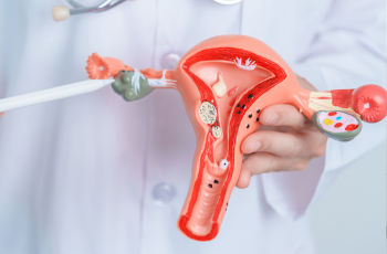 Ovarian Cysts