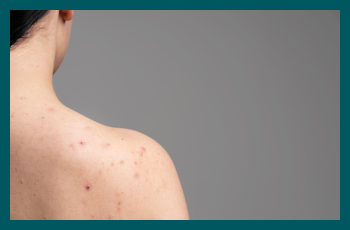 Red spots on skin: causes & when to worry? 